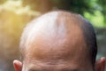 Head of man lose one`s hair, glabrous on his head for elderly ma Royalty Free Stock Photo