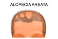 Head of a man suffering from alopecia areata Royalty Free Stock Photo