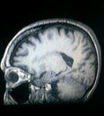 Head mri