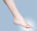 Healing blister on the foot. Concept photo with Color Enhanced s