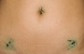 Healing the scars on the navel and abdomen of women after contemporary surgery