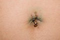 Healing the scars on the navel after surgery