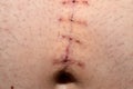 Surgical suture on a man s abdomen.