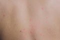 Health allergy skin care problem. Closeup young woman scratching her itchy back with allergy rash. Royalty Free Stock Photo