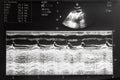 Echocardiography, ultrasound of the heart. Normal children`s result of a medical research method.