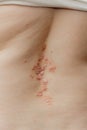 Health problem, skin disease, dermatitis on the back, close up. Psoriasis on skin Royalty Free Stock Photo