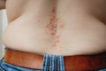 Health problem, skin disease, dermatitis on the back, close up. Psoriasis on skin Royalty Free Stock Photo