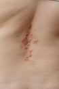 Health problem, skin disease, dermatitis on the back, close up. Psoriasis on skin Royalty Free Stock Photo