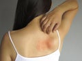 Health problem. woman scratching her itchy back with allergy rash