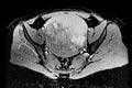 Abdomen-pelvic CT Scan showing uterine tumor (leiomyoma)