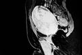 Abdomen-pelvic CT Scan showing uterine tumor (leiomyoma)