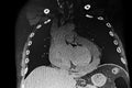 Chest CAT Scan showing pericardial effusion.