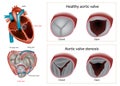 Healthy aortic valve or Aortic valve stenosis. Type of heart valve disease or valvular heart disease.