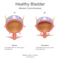 Healthy bladder in women. Royalty Free Stock Photo