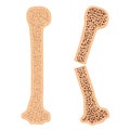 Healthy bone and broken bone with osteoporosis.