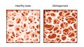 Healthy bone and Osteoporosis in comparison isolated on a white background
