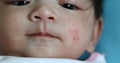 Healthy care baby allergic irritate dermatitis on face