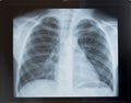 Healthy child chest x-ray:the ribs and lungs without damage