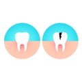 Healthy and damaged tooth. Caries disease. Royalty Free Stock Photo