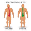 Healthy and diseased spine, scoliosis and normal condition, a medical training poster, vector illustration.