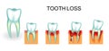 Healthy and diseased tooth. bleeding gums. tooth loss