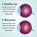 Healthy Eye Glaucoma