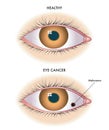 Healthy eye and with melanoma