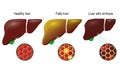 Healthy, fatty and cirrhosis of the liver