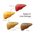 Stages of liver damage. Liver Disease.