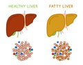 Healthy and fatty liver. Medical vector infographic.