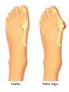 Healthy foot and foot with bunion