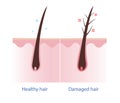 Healthy hair and damaged hair with scalp layer vector.