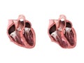 Healthy heart versus aneurysm,heart anatomy, Left ventricular aneurysm, wall bulge, transmural damage, develops, dislocation,