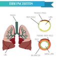 Healthy and inflamed bronchus. Chronic Bronchitis.