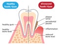 Healthy and inflammatory diseased gum. dental and health care concept