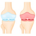 Healthy joint and osteoarthritis knee Royalty Free Stock Photo