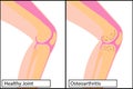 Healthy knee joint and osteoarthritis medical vector illustration