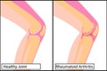 Healthy knee joint and Rheumatoid arthritis medical vector illustration