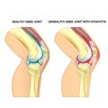 A healthy knee joint and unhealthy knee joint with synovitis. Vector