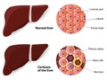 Healthy Liver and Cirrhosis