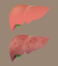 Healthy liver and a cirrhosis liver