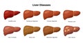 Healthy Liver and Liver diseases - fatty liver, hepatitis, fibrosis, cirrhosis, alcoholic hepatitis, liver cancer -