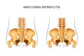 Healthy lower back and ankylosing spondylitis Royalty Free Stock Photo