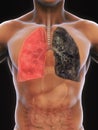 Healthy Lung and Smokers Lung Royalty Free Stock Photo