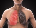 Healthy Lung and Smokers Lung Royalty Free Stock Photo