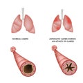 Healthy lungs and lungs with asthmatic disease. Realistic medical illustration.