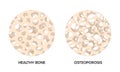 Healthy and osteoporosis bone, round illustrations on white background