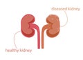 Healthy and painful kidney clipart. Pink clear parenchyma working organ and gray tumor covered ureter.