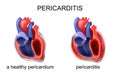 A healthy pericardium, pericarditis Royalty Free Stock Photo