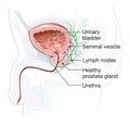 Healthy prostate with bladder, urethra and seminal vesicle, medical illustration